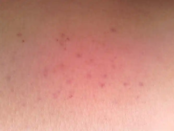 可自行消失血小板减少性紫癜它是一种以血小板减少为特征的出血性疾病