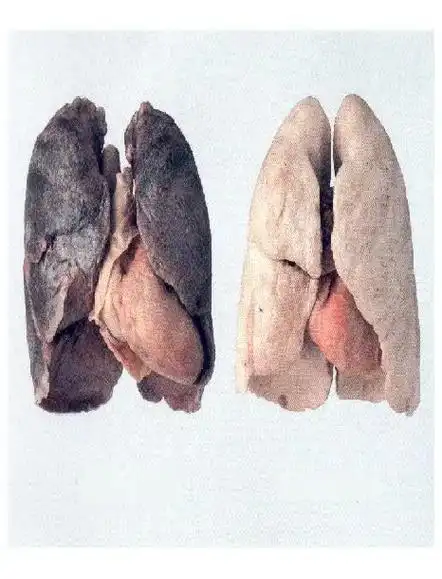 第一张是吸烟者的肺和正常人的肺的对比