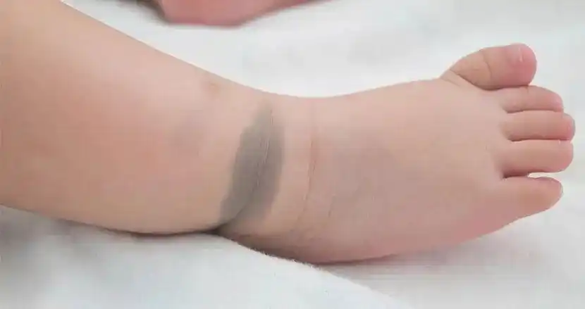 同样都是胎记为什么这种就需要做手术