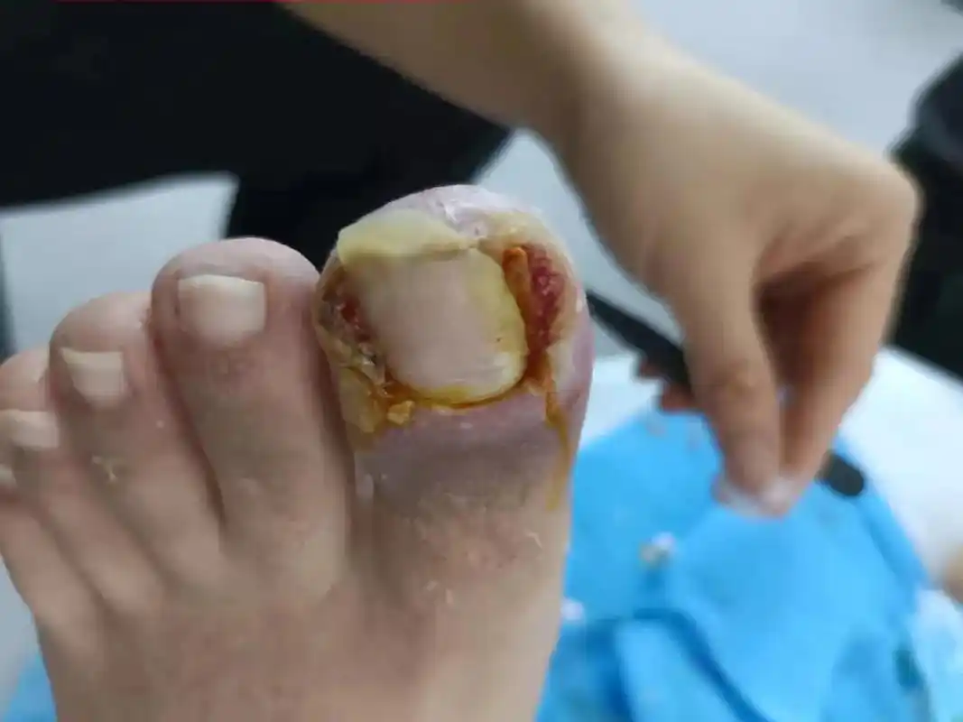 严重甲沟炎!治疗前和治疗后的对比! - 抖音