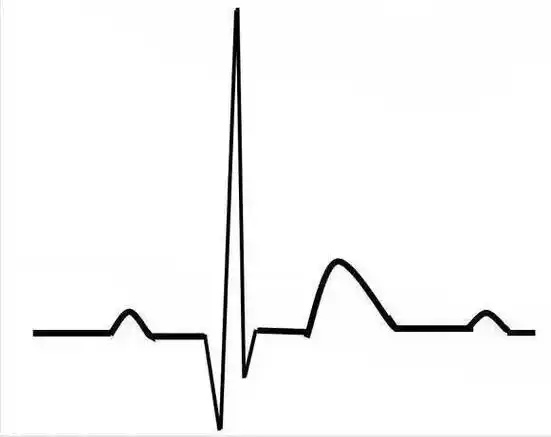 【基础】探清心脏病变的每个细节,请收藏心电图速成大法