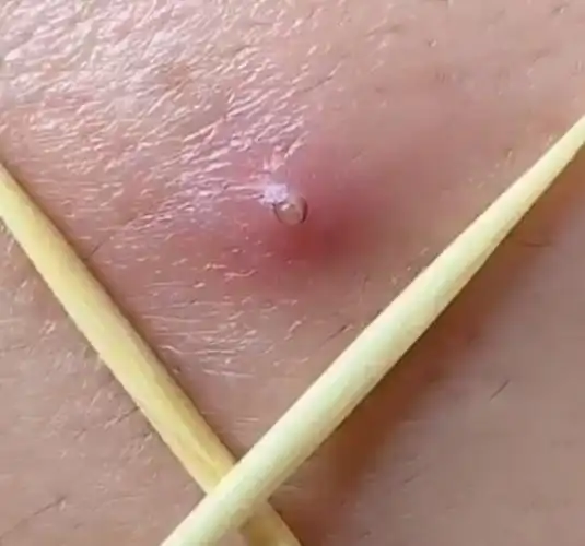 额头上起脓包,千万别手贱,这样处理干净又不留疤!