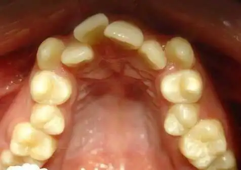 错颌畸形发病原因:遗传原因:错颌畸形的遗传因素,来源于种族演化和