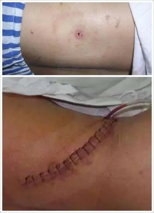 区首例经皮肾镜碎石取石术(气压弹道碎石 超声吸附) 写美篇 手术优势