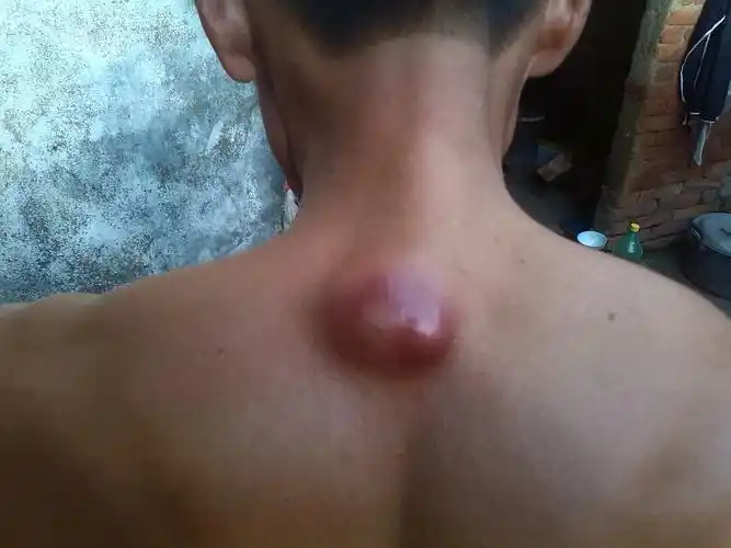 背部长了一个东西这是肿瘤吗去年曾经长过但是有消失了