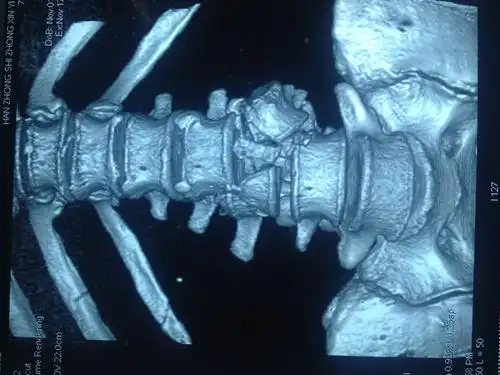 59岁男性腰椎爆裂骨折1例