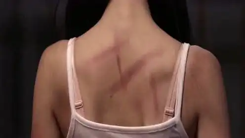 会痛的17岁:17岁女孩背后伤痕累累,看得我心疼不已!