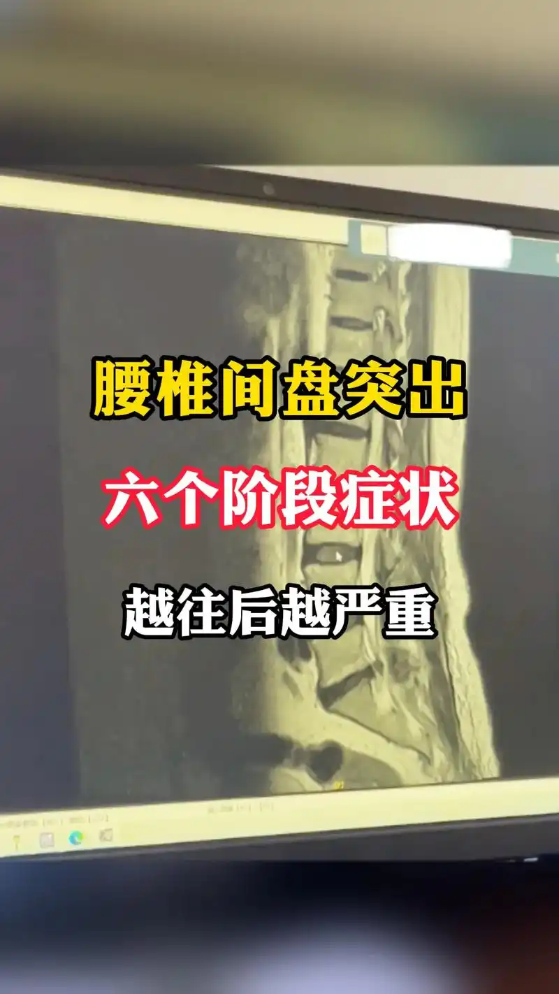 腰椎间盘突出六个阶段症状,越往后越严重. 1,腰疼:腰部持续性钝疼