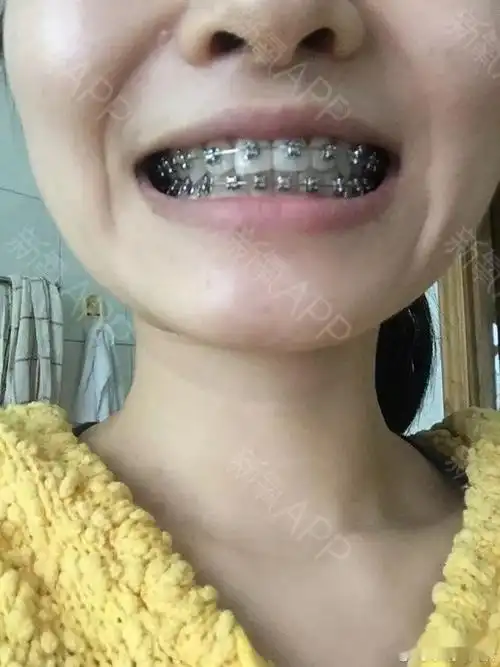 地包天,历时233天摘掉!医生给我的新婚礼物!一口大美牙!