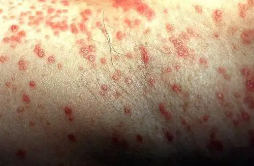 什么原因导致男性珍珠疹