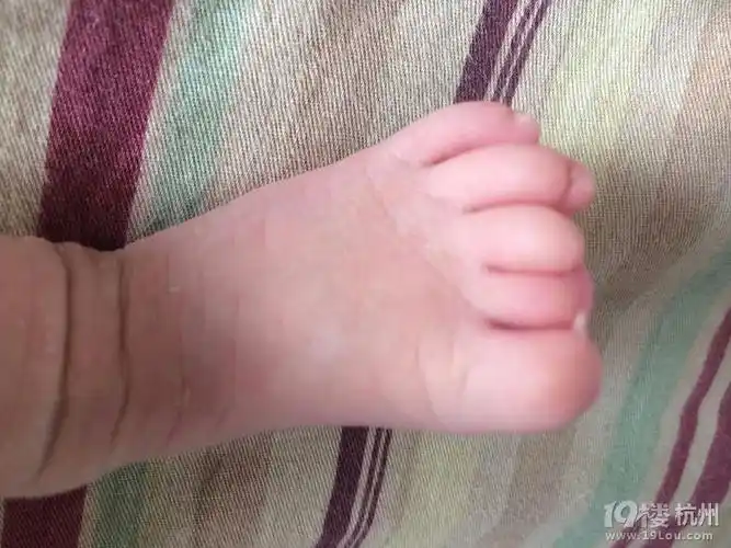 刚出生的女宝发现手指脚趾有畸形医院有责任吗求治疗方案