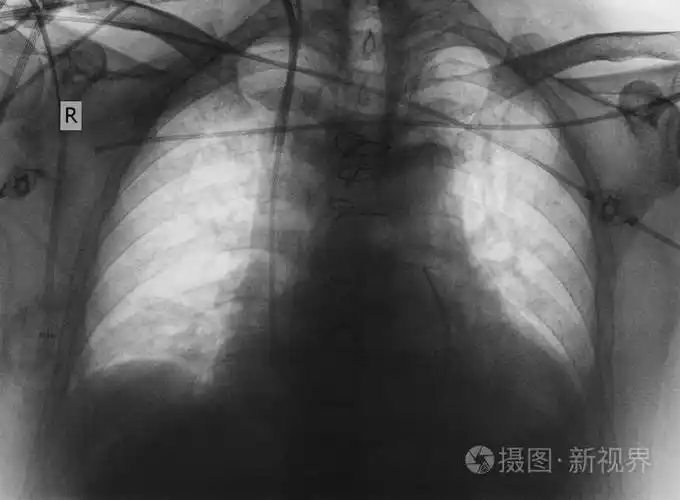 心脏和部的 x 射线图像