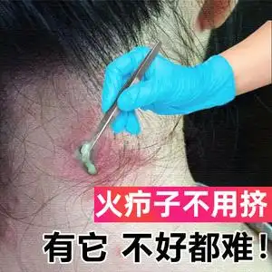 火疖子拔毒膏药贴坐板疮拔脓吸脓膏红肿硬块痘痘屁股疖子拔毒神器