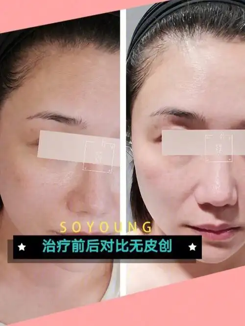 光子嫩肤做完一次不太明显怎么办