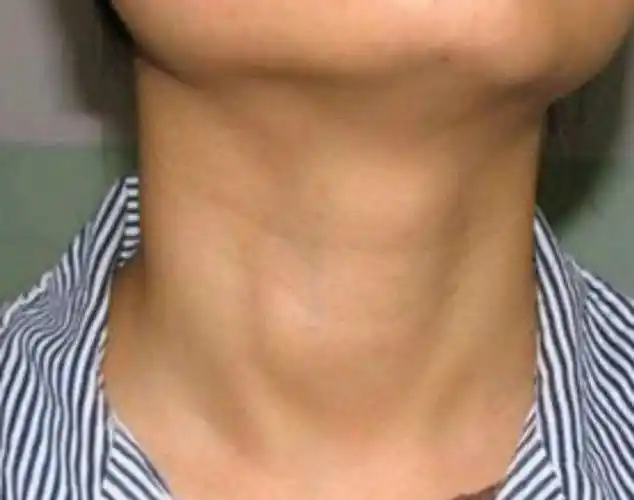 为何女人更容易"招惹"甲状腺结节?又该如何避免结节"病变"?