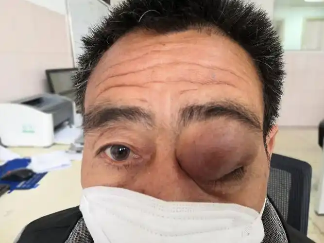 我住院管理的一眼眶肿瘤的患者 - 好大夫在线