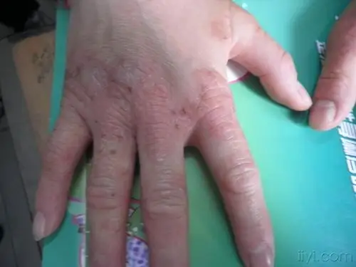 系列皮肤病手部湿疹及治疗效果