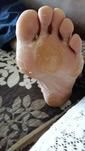 我舅舅是一个糖尿病患者去年开始脚底就有脱皮的现象现在脚底