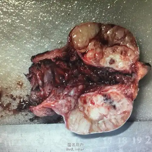 睾丸癌化疗影响生育吗 睾丸癌到底应该怎么办?