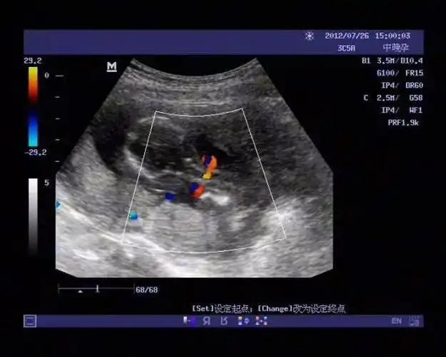 脐带绕颈怎么办,对胎儿有危险么?