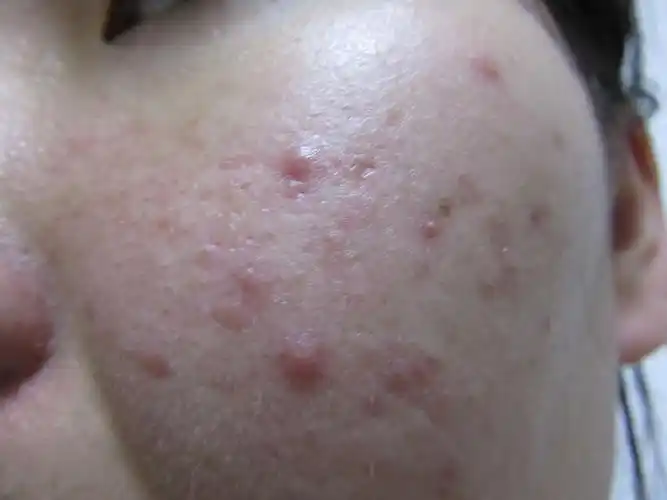 求大神推荐治疗青春期痘痘的日常方法!急