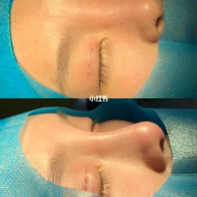 线雕鼻即刻效果!_医美整形_美妆