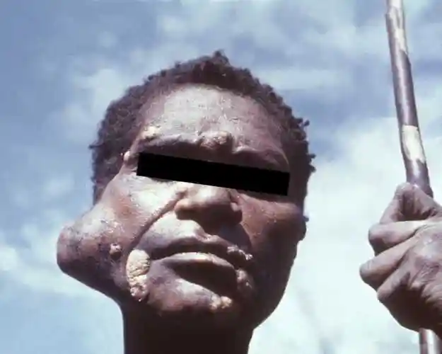 12170-parotid-salivary-gland-tumor-public-health-image-library