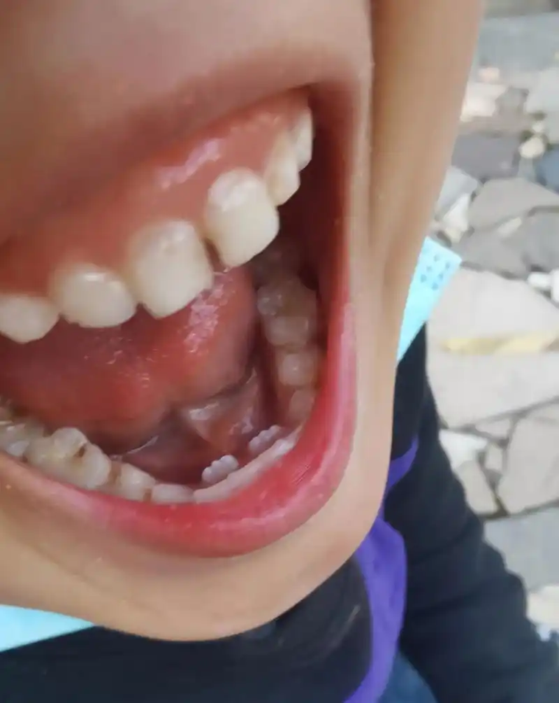 真愁人,乳牙没掉,新牙长出来了!这种情况,需要拔牙吗?