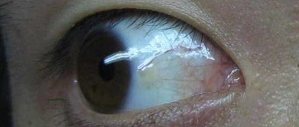 睑裂斑怎么才能消失