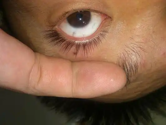 眼结石图片 (33)