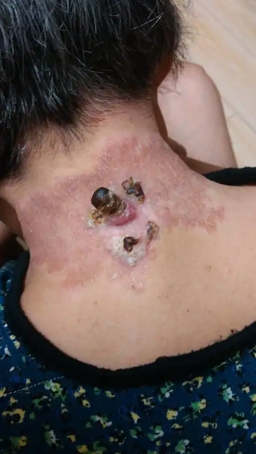 医生你好我在八岁的时候脖子被炉火蹦出的煤屑烧伤落下直径月1