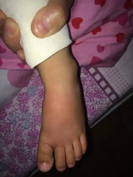 5岁小女儿右脚向脚掌无名肿痛,医院医生也没说出123来,为什么?