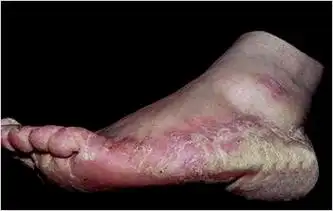 角化型足癣用什么药有效