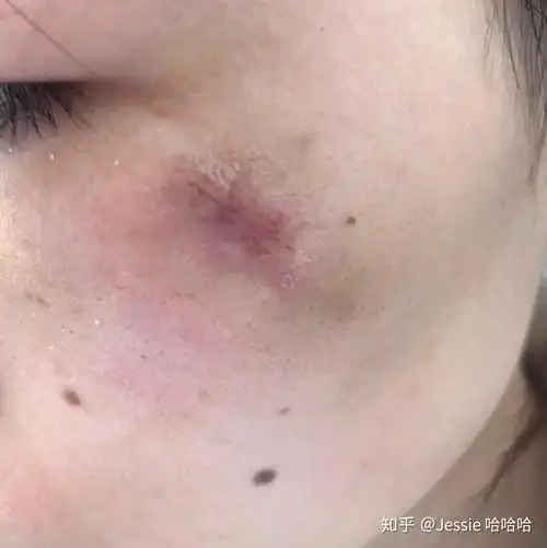 手术切除粉瘤(皮脂腺囊肿)是一种什么样的体验