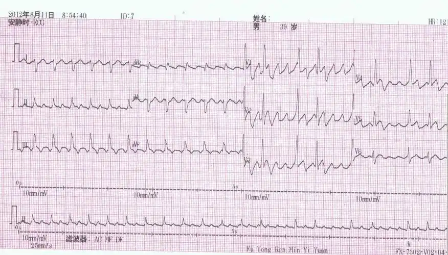 房扑,房颤 - 心电图脑电图专业讨论版 - 爱爱医医学论坛 - 爱爱医医学