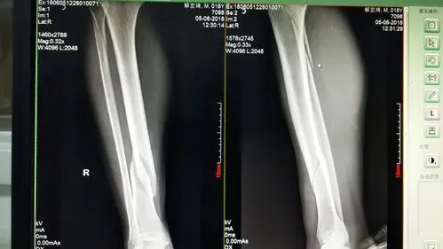 患者受伤后拍的x光片:右胫腓骨骨折明显错位