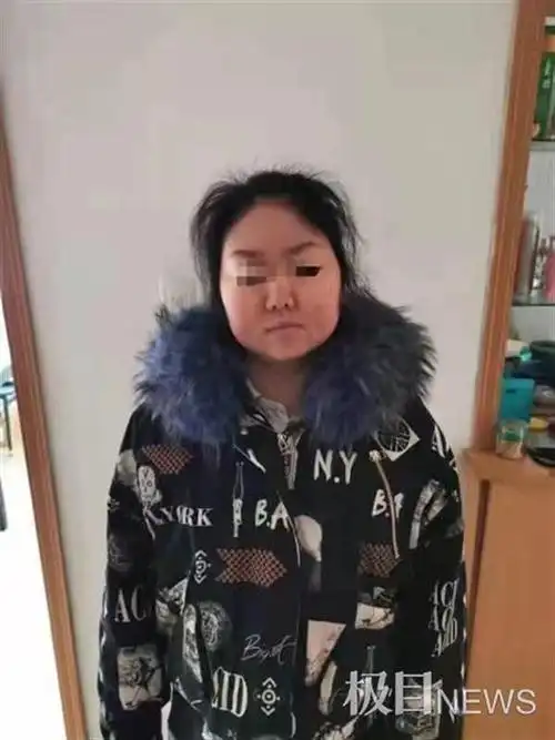 28岁女子面容发生改变,满月脸水牛背,血压飙升例假紊乱总是不孕,跑遍