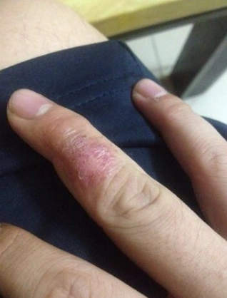 水疱型手癣图片 (50)