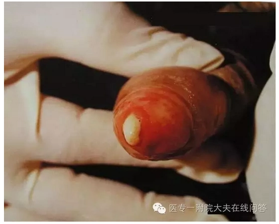 尿道炎,也是临床发病率非常高的性病,在欧美国家已经超越淋病排在首位