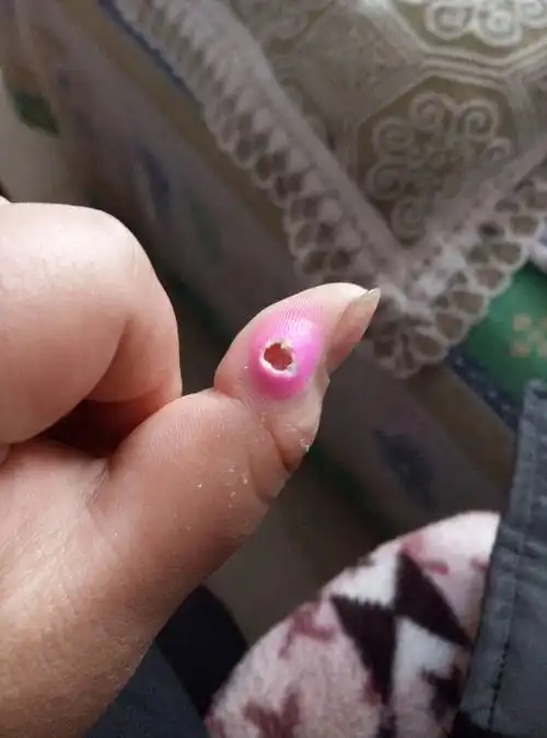 手上长了个鸡眼,买了鸡眼膏贴了,把上面的白色皮去掉,里面是肉了,不