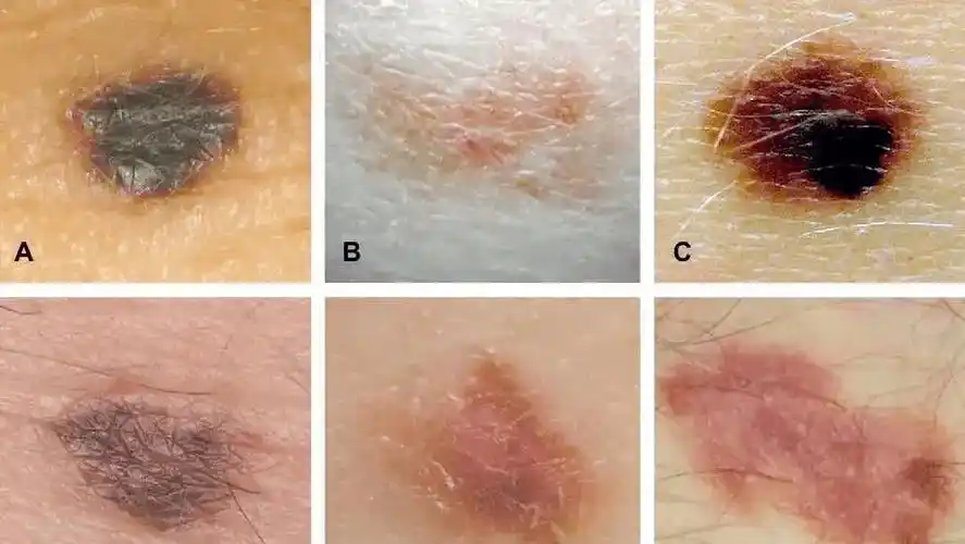 2.spitz痣:作为一种较为少见的黑素细胞病变,常发生于儿童或青少年.