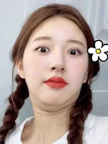 是下颌部位皮下脂肪增多堆积或是皮肤松弛的结果,双下巴与面部表情肌