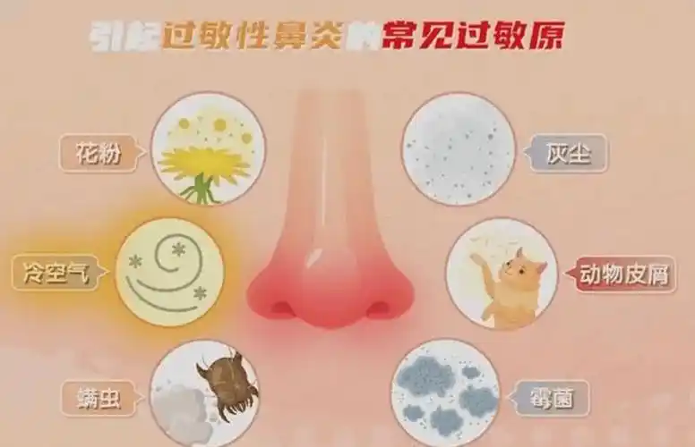 春季过敏性鼻炎频频高发提前掌握预防妙招再也不用活受罪