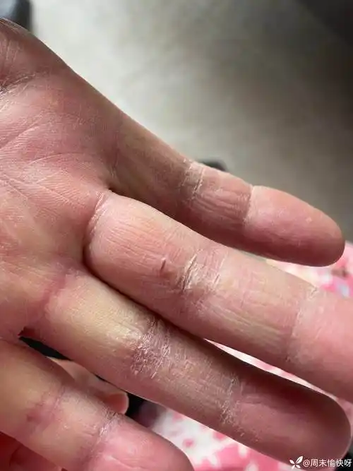 角化皲裂性湿疹