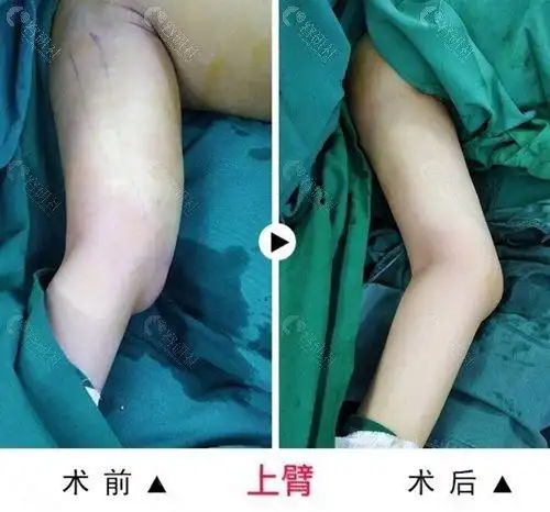 西安画美上臂吸脂前后对比照
