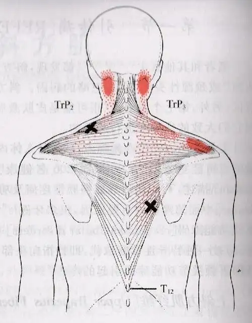 2,定点斜方肌激痛点:上斜方肌前缘中部,肩胛冈内侧缘,枕骨下项线等.