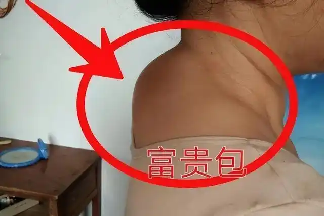 导语:从医学角度来看,富贵包其实是由颈椎管狭窄症引