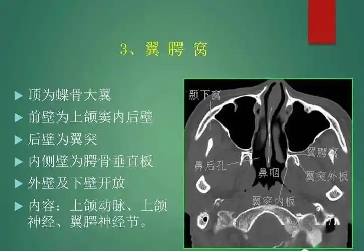 翼窝,颞下窝,翼腭窝