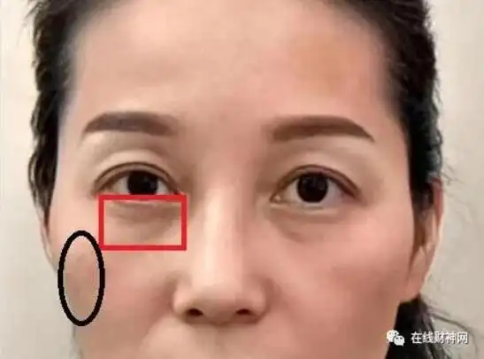 插图详解泪堂凹陷(卧蚕塌陷)孤寡相,孤寡相的风水破解方法