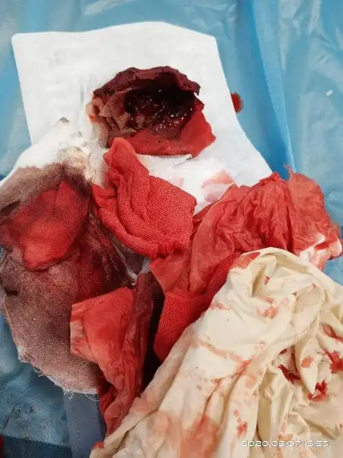 图片里的出血量只是九牛一毛   纱布里是坏死的组织.